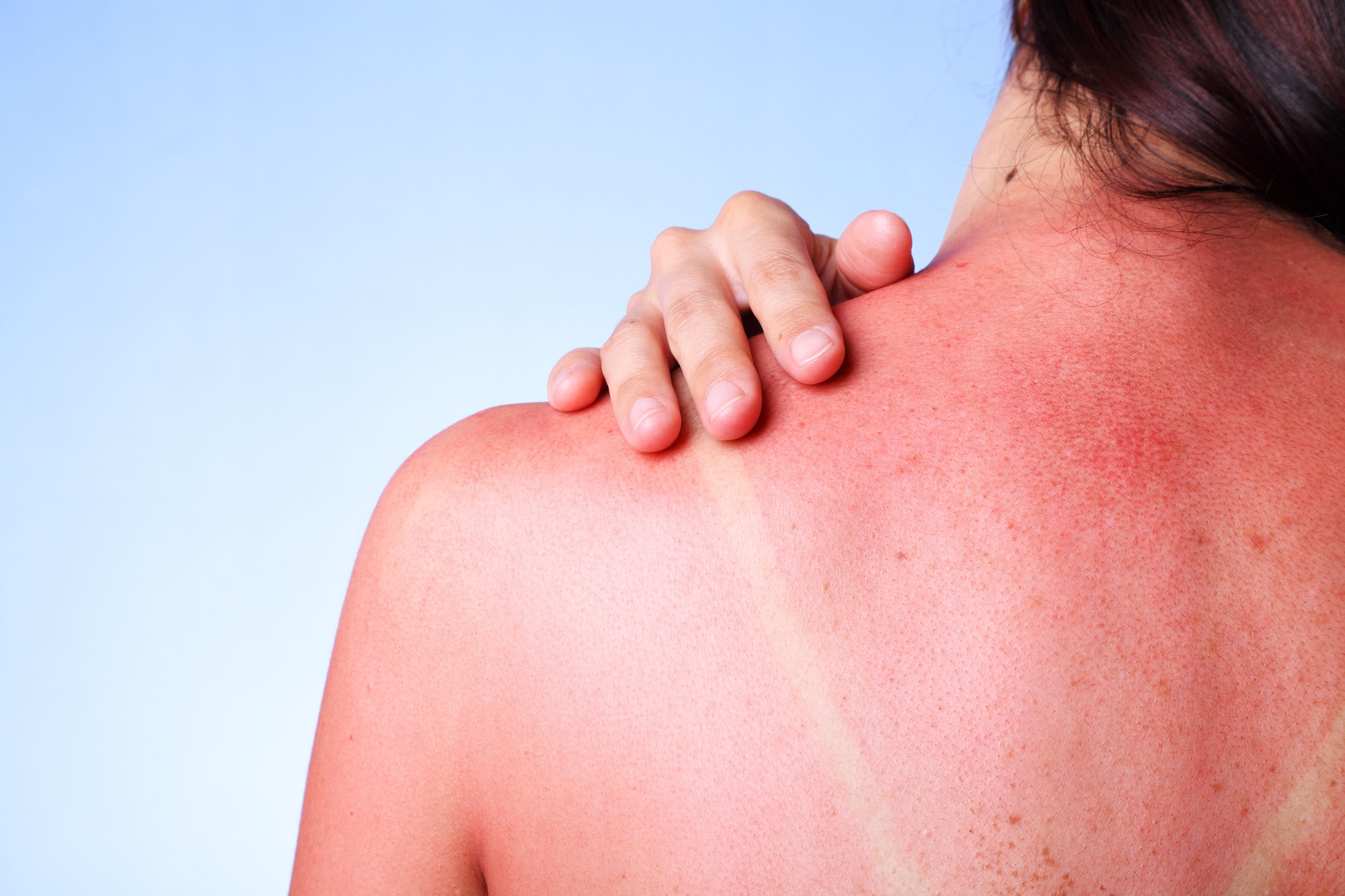 woman with severe sunburned back