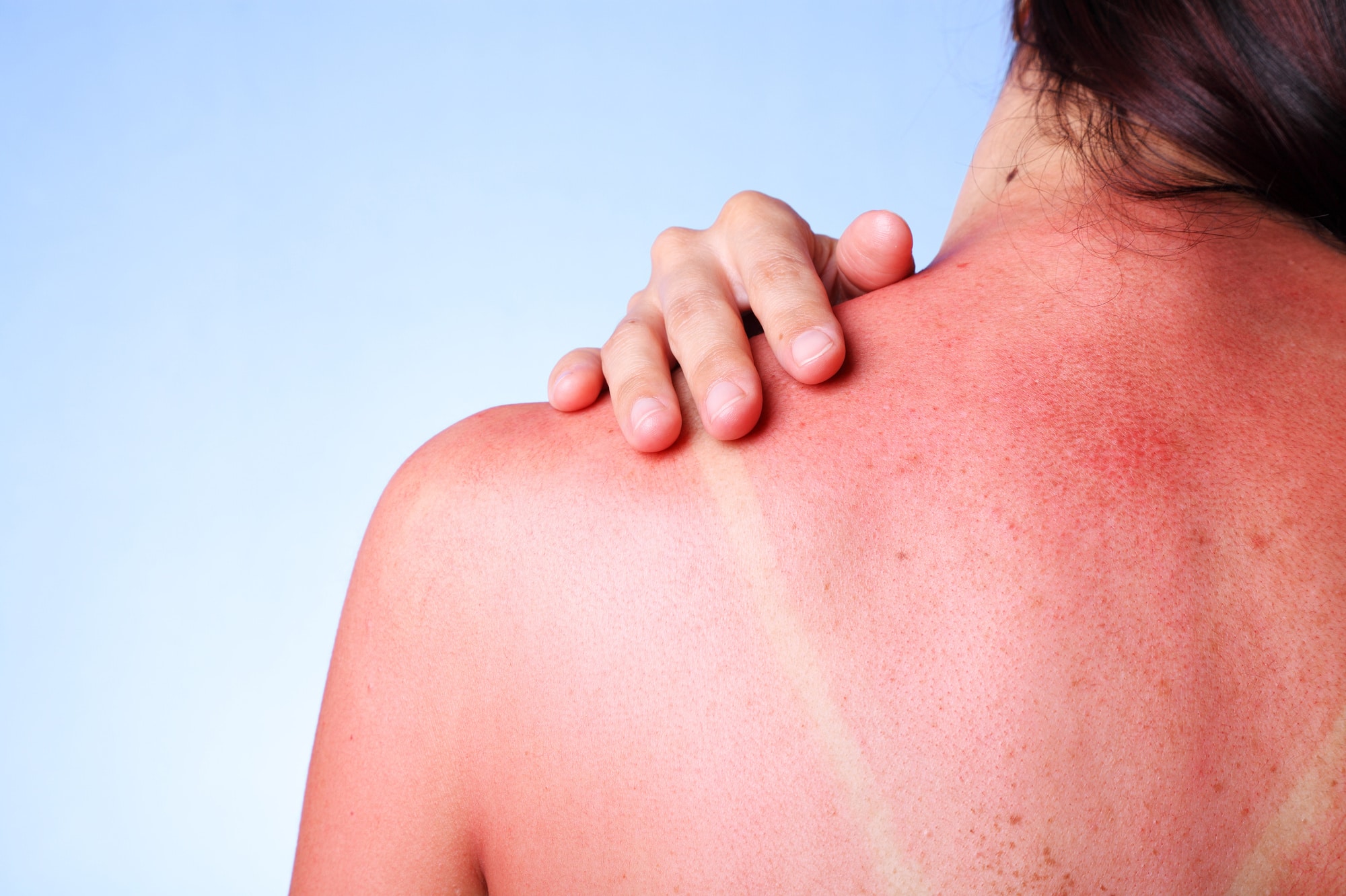 7 Natural Remedies to Soothe Sunburnt Skin