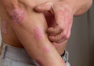 different types of eczema