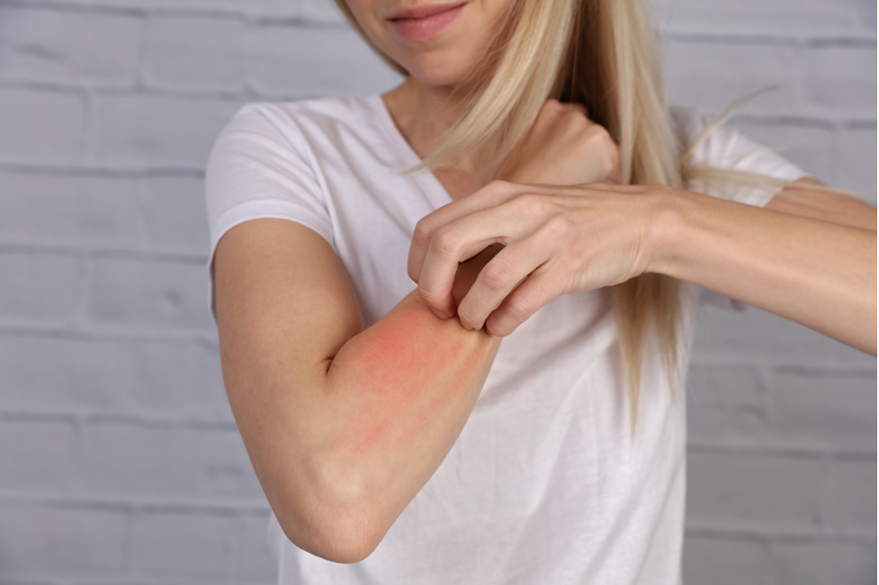 A woman scratching an allergic reaction