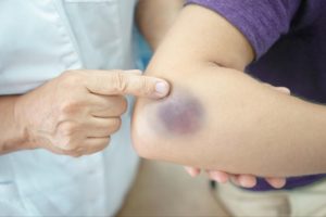 A closeup image of a doctor holding a patient’s arm in their hand while examining and pointing to a bruise near their elbow.