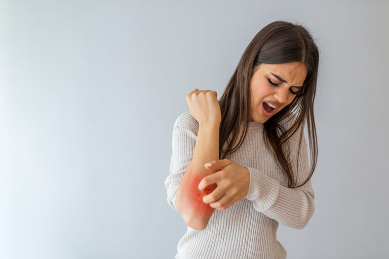 Psoriasis Flare-Ups: Find Urgent Care on the Emerald Coast